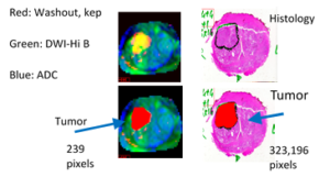 Examples of RGB (red=Washout, kep, green=DWI-Hi B, blue=ADC) and histology images taken from Patient #11, Slice #4. The tumor is displayed in yellow in the RGB images and outlined by a pathologist. The red areas below each image denote the tumor areas in each image (239 and 323, 196 pixels in MRI and histology images respectively. Accounting for spatial resolution results in a scaled (to 1mm per pixel) pixel number of 145 pixels.