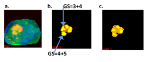 Prostate displayed as color where red is kep green is DWI-High B blue is ADC b. Gleason scoring inside tumor using Maximum SAM with Whitened-DeWhitened signatures c. Gleason Scoring Weighted SAM using Whitened-DeWhitened signatures